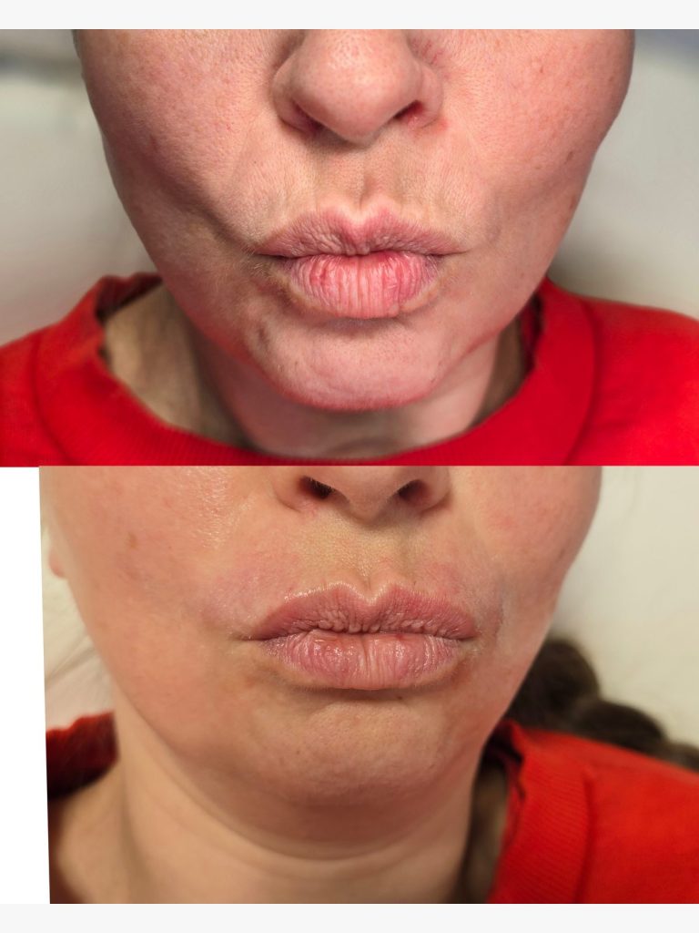 Before and after filler for smoker's lines around the mouth at Beauty Maison Aesthetics in Maple, Vaughan (individual results vary)