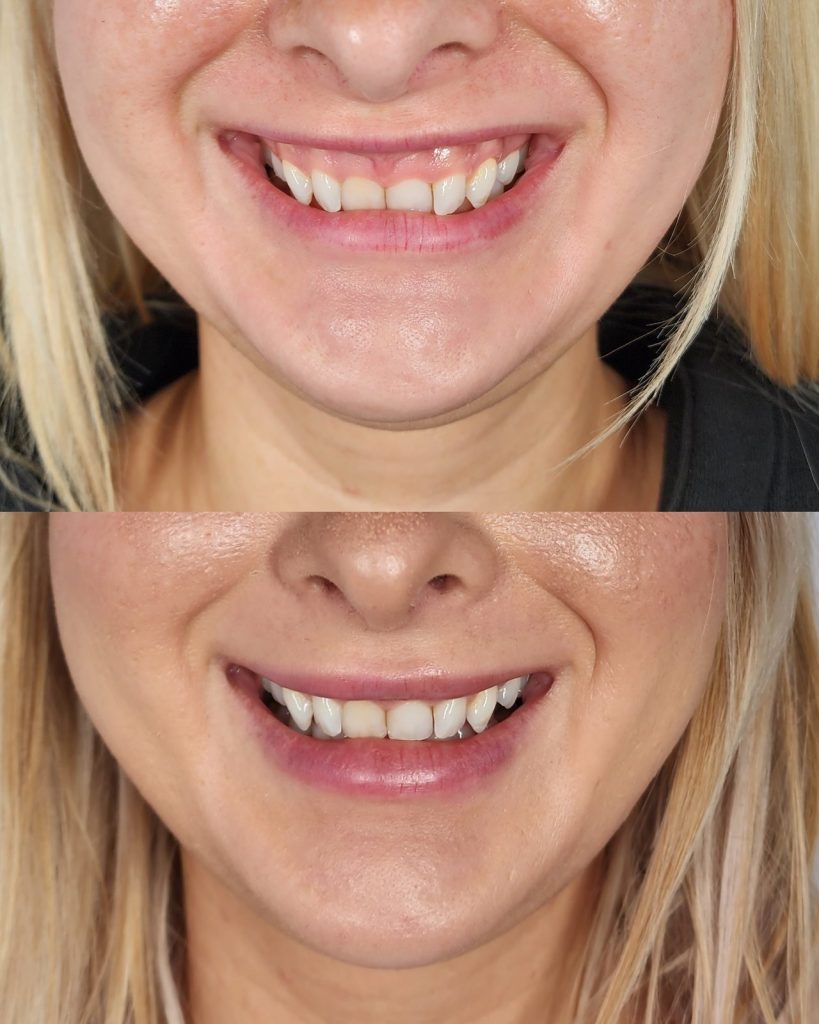 Before and after wrinkle relaxer at Beauty Maison Aesthetics in Maple, Vaughan (individual results vary)