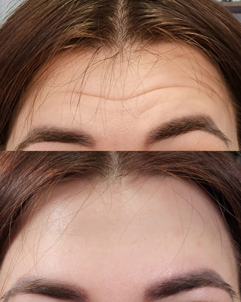 Before and after wrinkle relaxer at Beauty Maison Aesthetics in Maple, Vaughan (individual results vary)