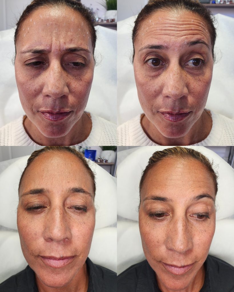 Before and after wrinkle relaxer at Beauty Maison Aesthetics in Maple, Vaughan (individual results vary)