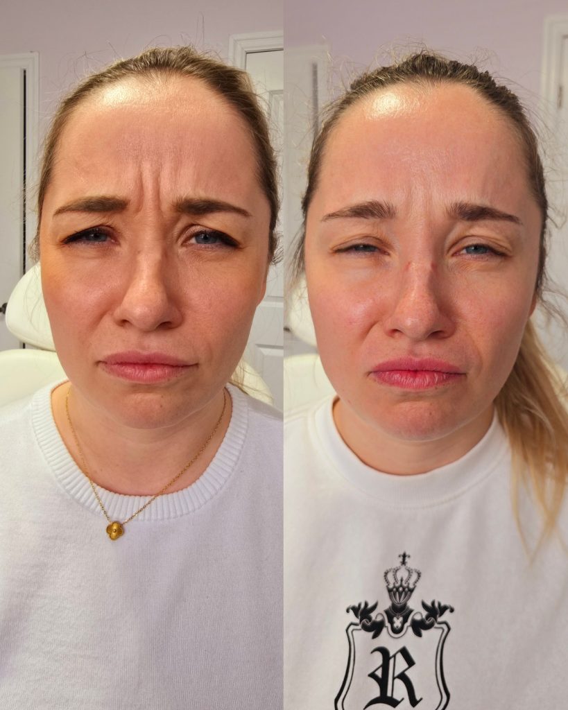 Before and after wrinkle relaxer at Beauty Maison Aesthetics in Maple, Vaughan (individual results vary)