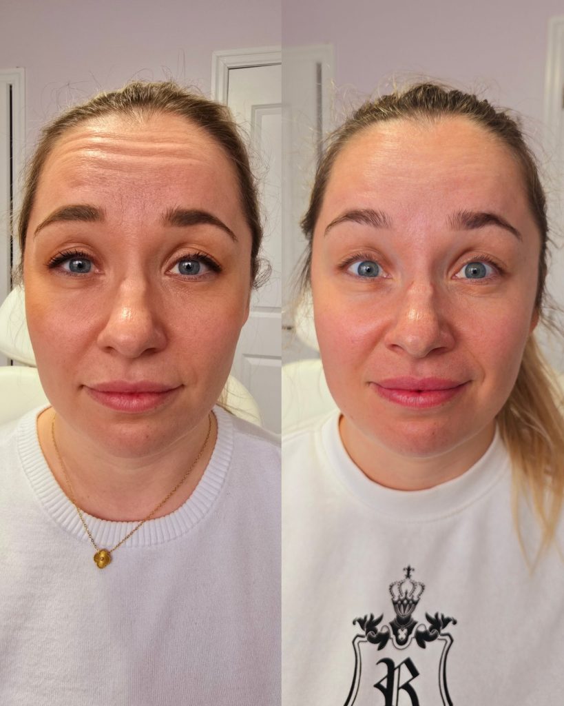 Before and after wrinkle relaxer at Beauty Maison Aesthetics in Maple, Vaughan (individual results vary)