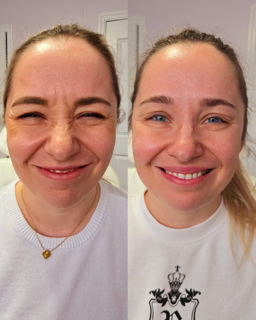 Before and after wrinkle relaxer at Beauty Maison Aesthetics in Maple, Vaughan (individual results vary)