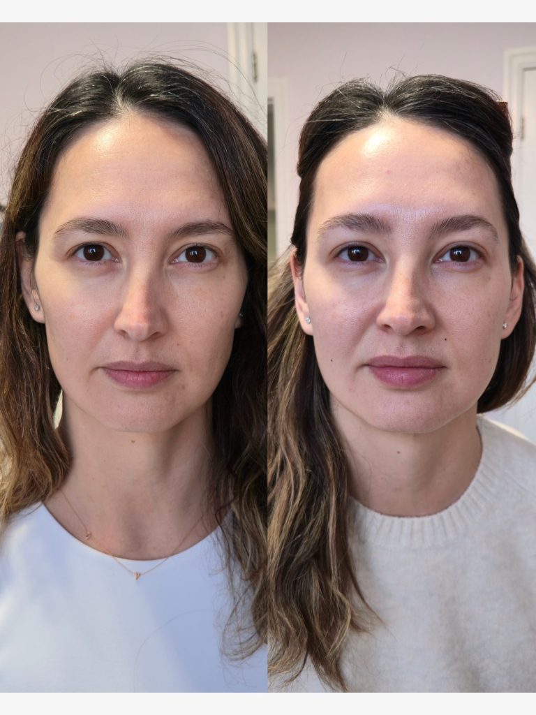 Before and after botulinum toxin treatment, front view at Beauty Maison Aesthetics in Maple, Vaughan (individual results vary)